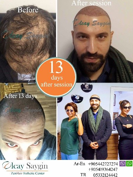 زراعة الشعر في تركيا الدكتورة اولجاي سايقن