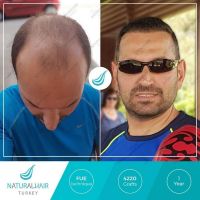 زراعة الشعر و اللحية في تركيا 